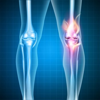 Knee-Arthritis_274144778